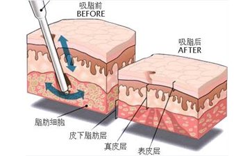 廣州哪家機構吸脂減肥比較好