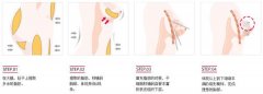 廣州自體脂肪豐胸效果好不好呢