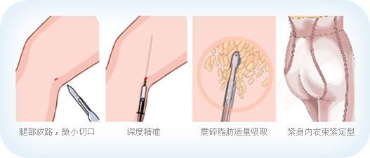 吸脂瘦腿手術后多長時間可以恢復呢