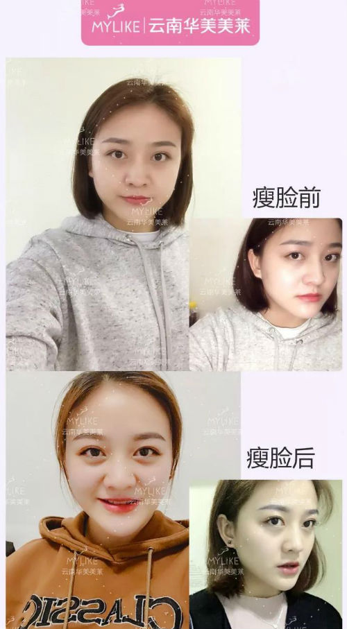 打完瘦臉后什么時候才會有效果