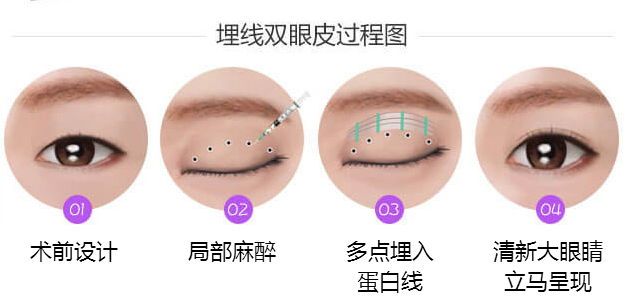 做埋線雙眼皮會不會有危險