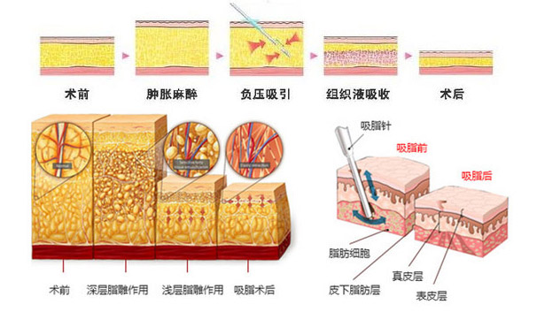 廣州美萊吸脂減肥術后效果行不行呢