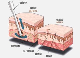 面部吸脂