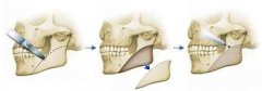 福州下頜角整形手術是怎樣的