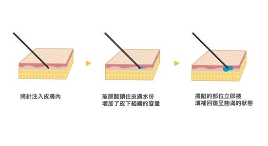 注射玻尿酸除皺