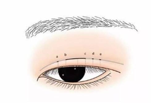 福州做全切雙眼皮術后需要注意事項有哪些