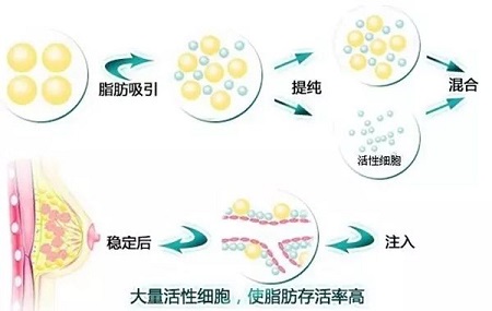 自體豐胸手術價格