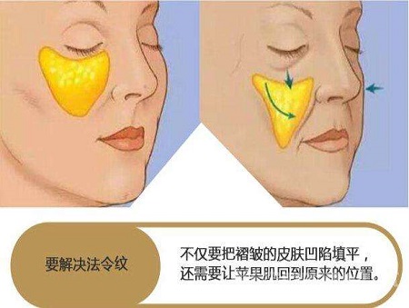 脂肪填充法令紋能維持多少時間？