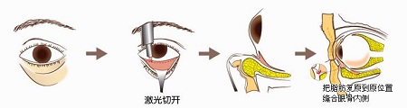 激光去眼袋手術