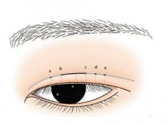 廈門割雙眼皮術后的疤痕能自然退掉么