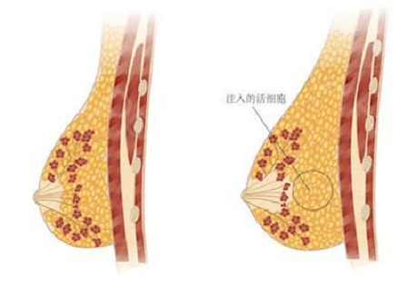 做自體脂肪豐胸手術會不會出現硬塊的現象