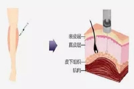 重慶做大腿抽脂手術后護理措施有哪些