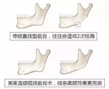 方臉妹紙做完下頜角