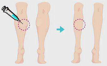 一針瘦腿多少錢？