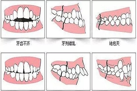 牙齒矯正的優點是什么