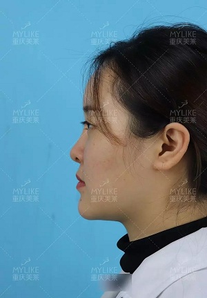 “鼻綜合”后假又歪，還攣縮？鼻修復還原自然生態美鼻