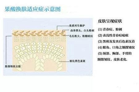 擠痘竟然被送進ICU！你的痘痘還好嗎？