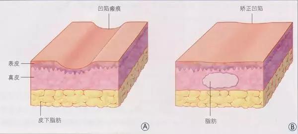 自體脂肪填充為什么需要二次補打？