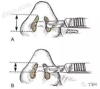 隆鼻手術切口在哪里？才能自然不留疤
