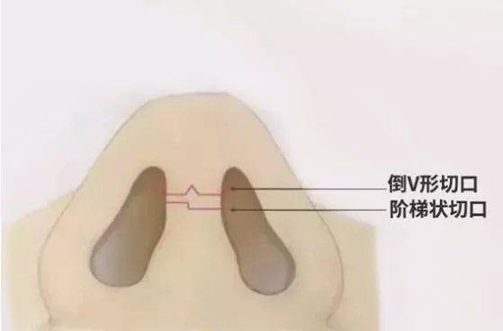 隆鼻手術切口在哪里？才能自然不留疤