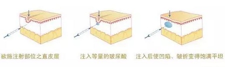 法令紋、川字紋