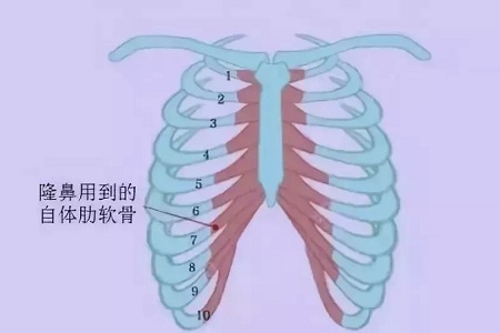 什么，隆鼻方式竟然有這么多種？