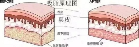 醫美白皮書：吸脂等于減肥嗎？