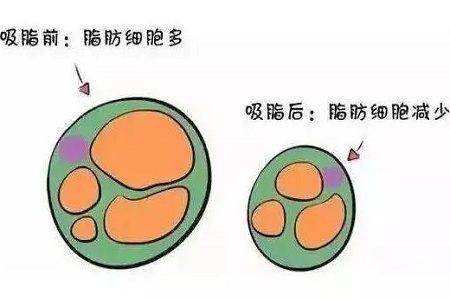 關于吸脂那些不能說的秘密，今天要在這里一次說完！