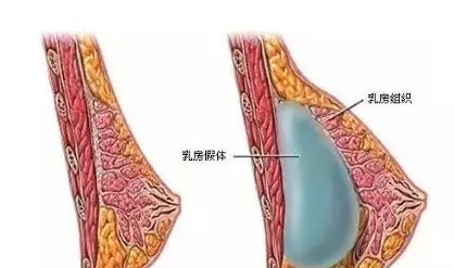 自體脂肪or假體隆胸，我到底應該怎么選？