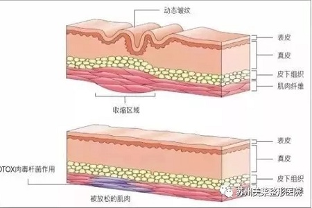 你無法用玻尿酸除掉所有皺紋！