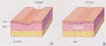 明星的臉和你的臉差的只是這一步！--面部脂肪填充