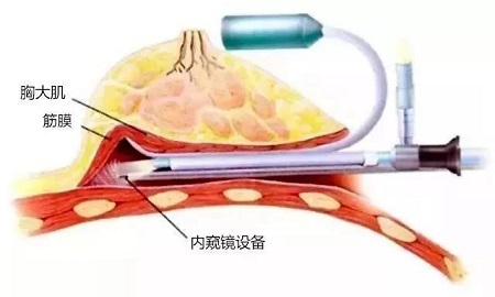 乳房整形