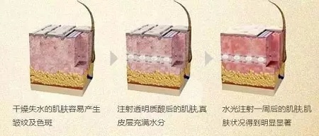 水光，打1次和4次究竟有多大區別？