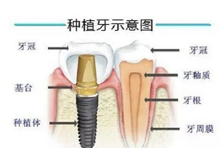 揭秘牙齒矯正的全過程?。?！