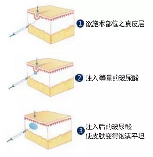 用玻尿酸治療鼻唇溝，一定要注意這種情況！