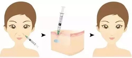 用玻尿酸治療鼻唇溝，一定要注意這種情況！