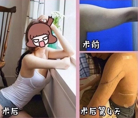 吸脂手術