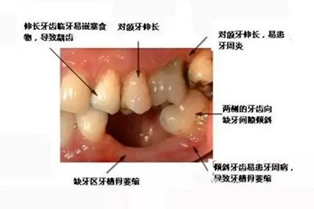 牙齒缺失時，選烤瓷牙還是那種？