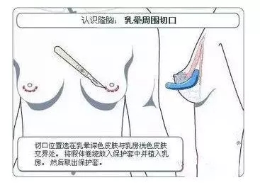 假體隆胸的三種切口應該怎樣選擇