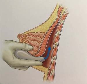 假體隆胸的三種切口應該怎樣選擇
