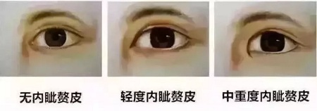 雙眼皮開眼角