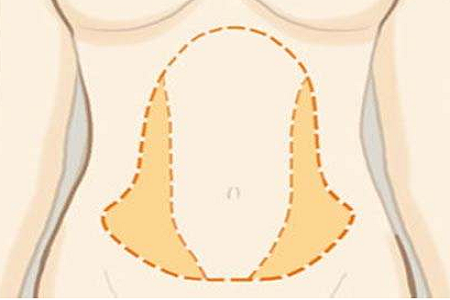 腰部吸脂手術
