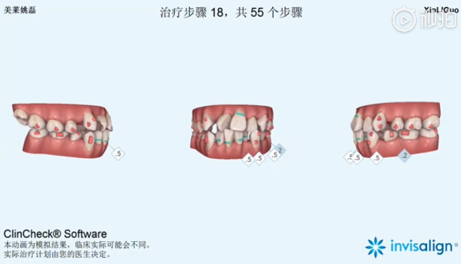 南京美萊口腔全景側位片，拍照取模，動畫方案設計