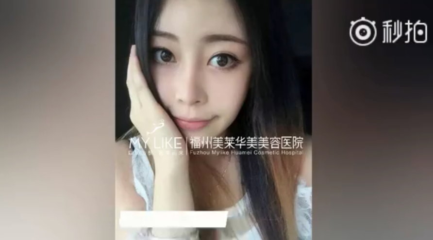 福州美萊鼻子幾毫米的改變，自信百倍的蛻變