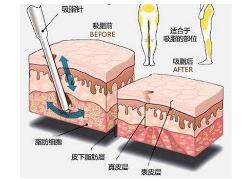 鄭州美萊吸脂瘦身等于減重？