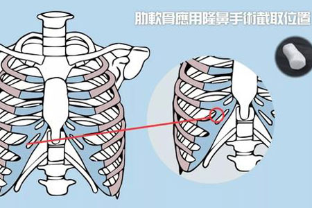 深圳隆鼻醫院做軟骨隆鼻多少錢