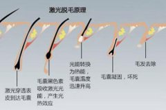 蘇州脫毛醫院做冰點脫毛的價格多少，對身體有沒有傷害