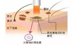 西安整形醫院做點陣激光多少錢，一次有效果嗎