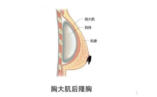 假體隆胸