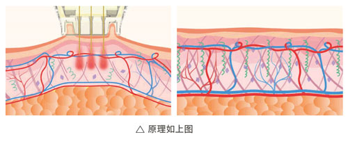 超光子+水光，“撐起”皮膚彈、潤、緊